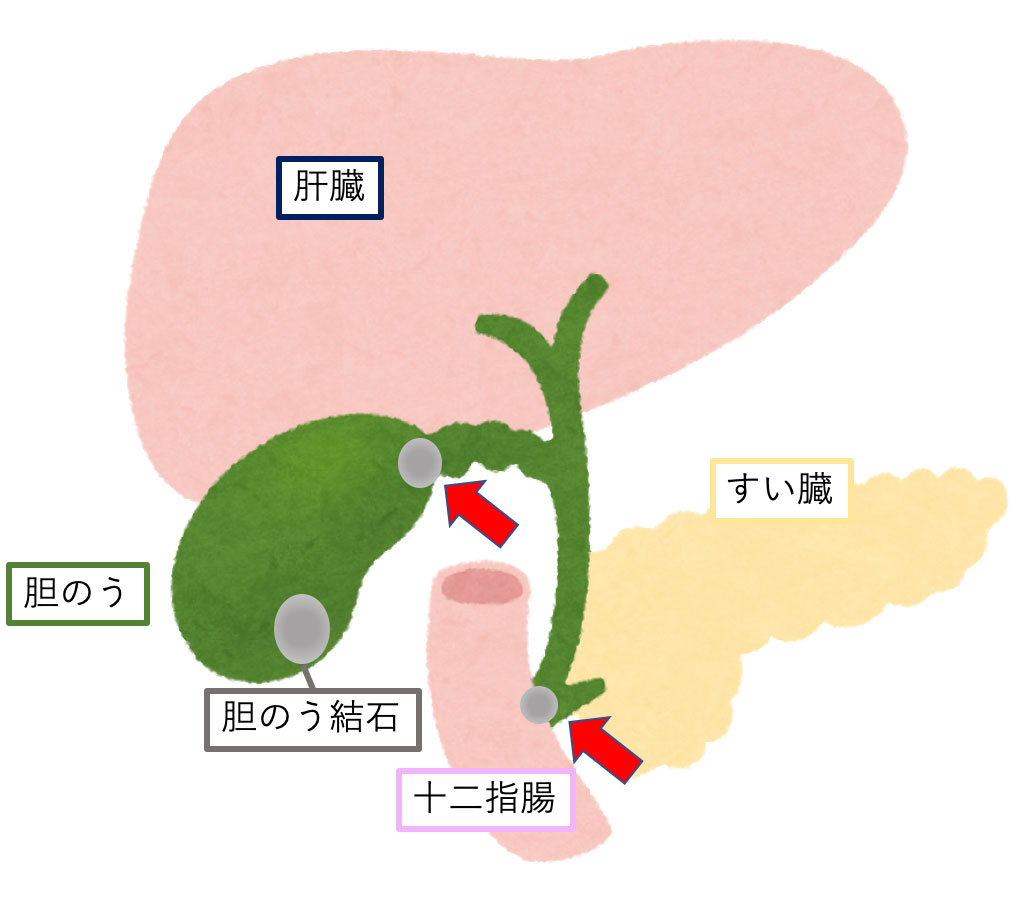 胆嚢 原因 急性 炎