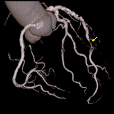 冠動脈CT（左冠動脈前下行枝の高度狭窄）