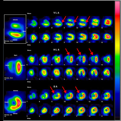 負荷心筋シンチグラフィー（左室前壁、心尖部の虚血）