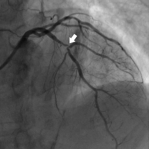 左前下行枝の高度狭窄