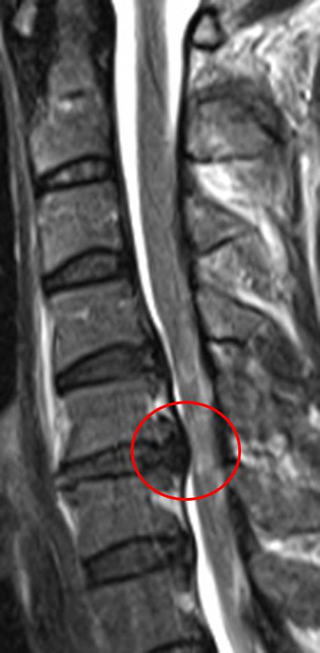術前 赤丸部分で脊髄が圧迫されている