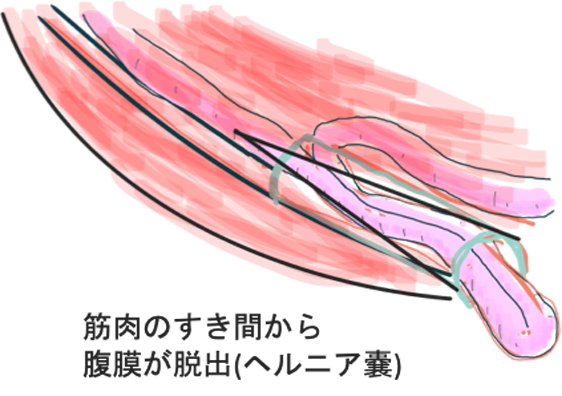 大腸がんのイラスト